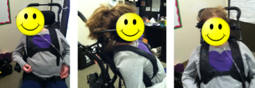 A client in a wheelchair with a lateral head flexion to the right and a side by side comparison of increased forward head position after intervention