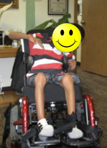 Young boy in a wheelchair with increased muscle tone causing him to lean to the left side
