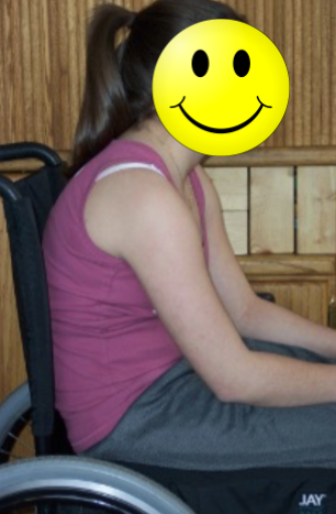 Girl demonstrating a posterior pelvic tilt and kyphosis in a manual wheelchair