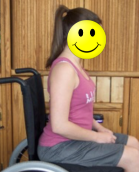 A girl in a wheelchair demonstrates an anterior pelvic tilt and increased lumbar lordosis.