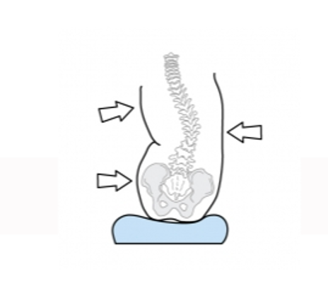 Illustration showing with arrows where to apply force/counterforce for a scoliotic spine