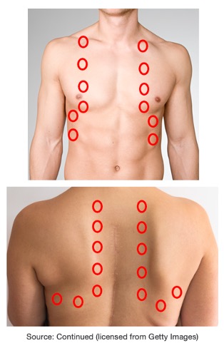 Diagram of where to perform percussion on a patient