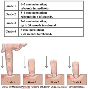 Scale for grading of edema