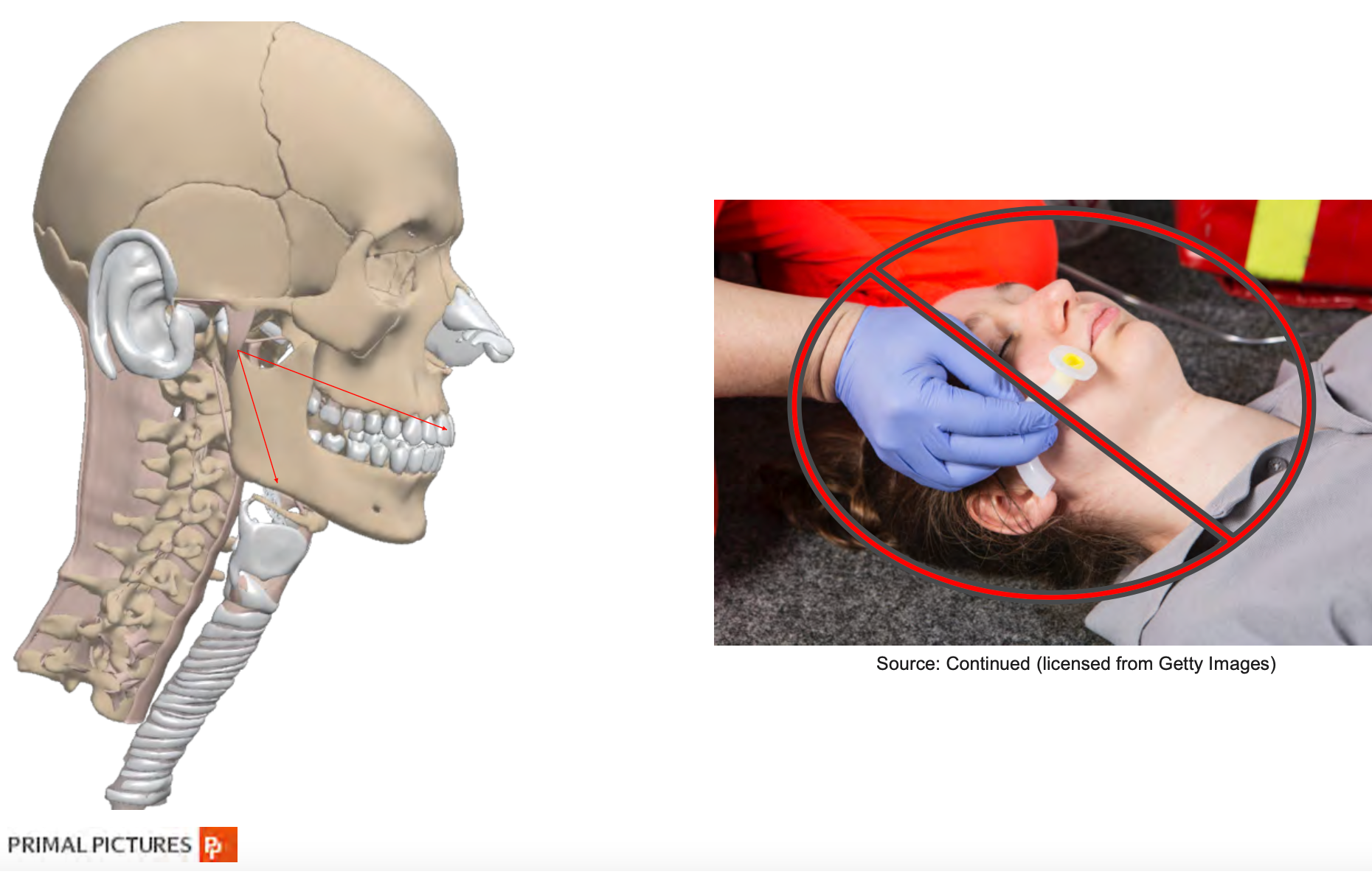  Oropharyngeal Airway Size in Adults