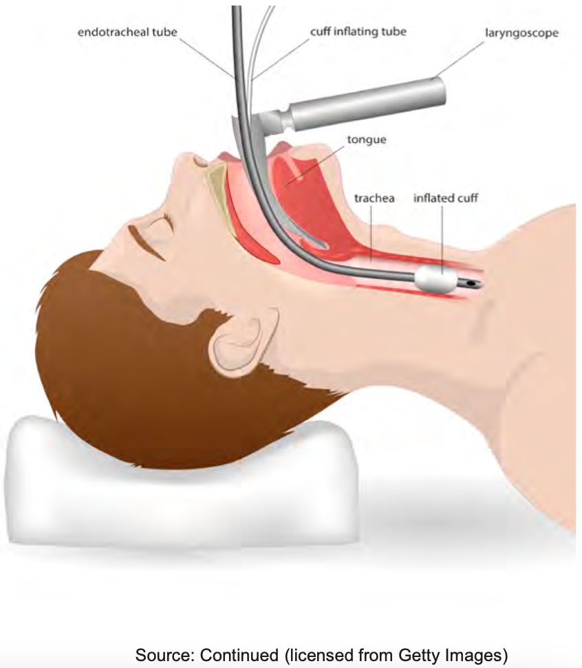  Illustration of endotracheal tube an inflated cuff