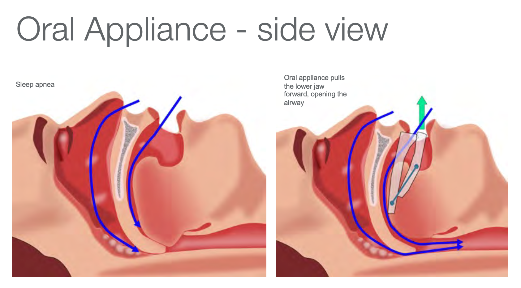 Types of Sleep Apnea Treatment (Include Inspire Upper Airway Stimulation  therapy) » Head & Neck Surgical Associates