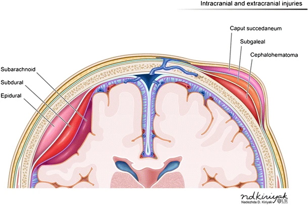 Image depicting hemorrhages by location 