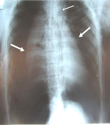 Chest Xray showing pneumothorax