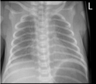 Xray showing ground glass lungs with hypoinflation