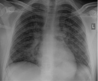 Xray of lungs showing pneumonia