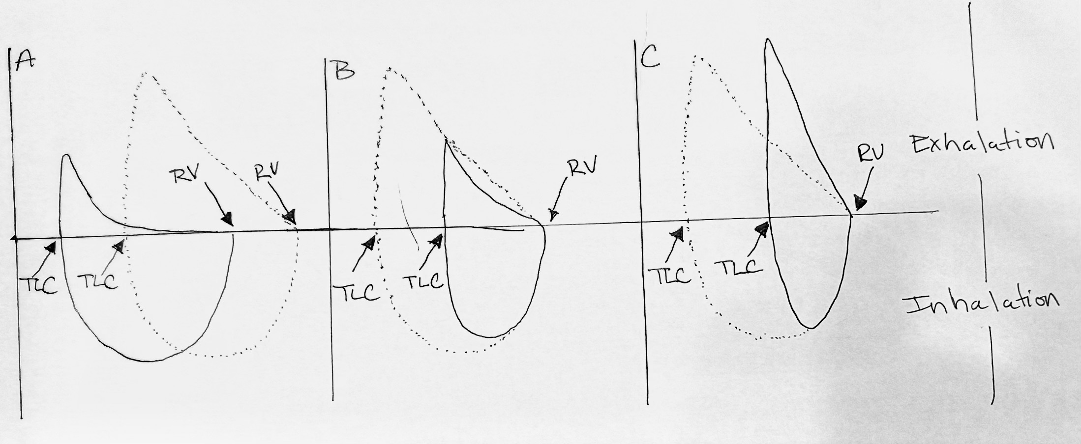 Flow-volume loop and volume time graph of pulmonary function test.