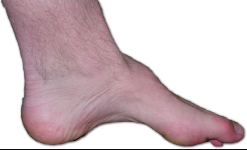 The foot of a person with Charcot-Marie-Tooth. 