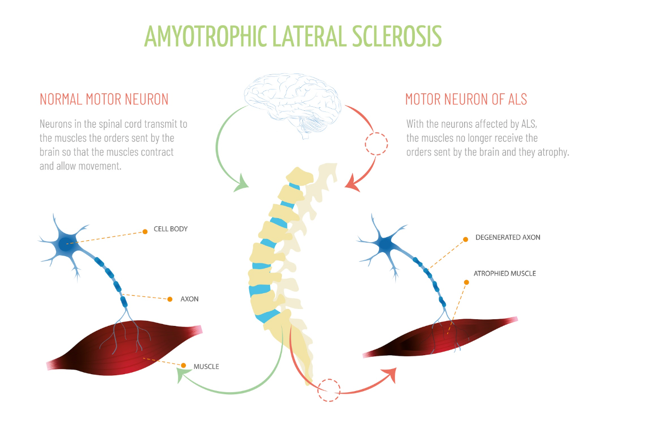 Motor neuron diagram of ALS