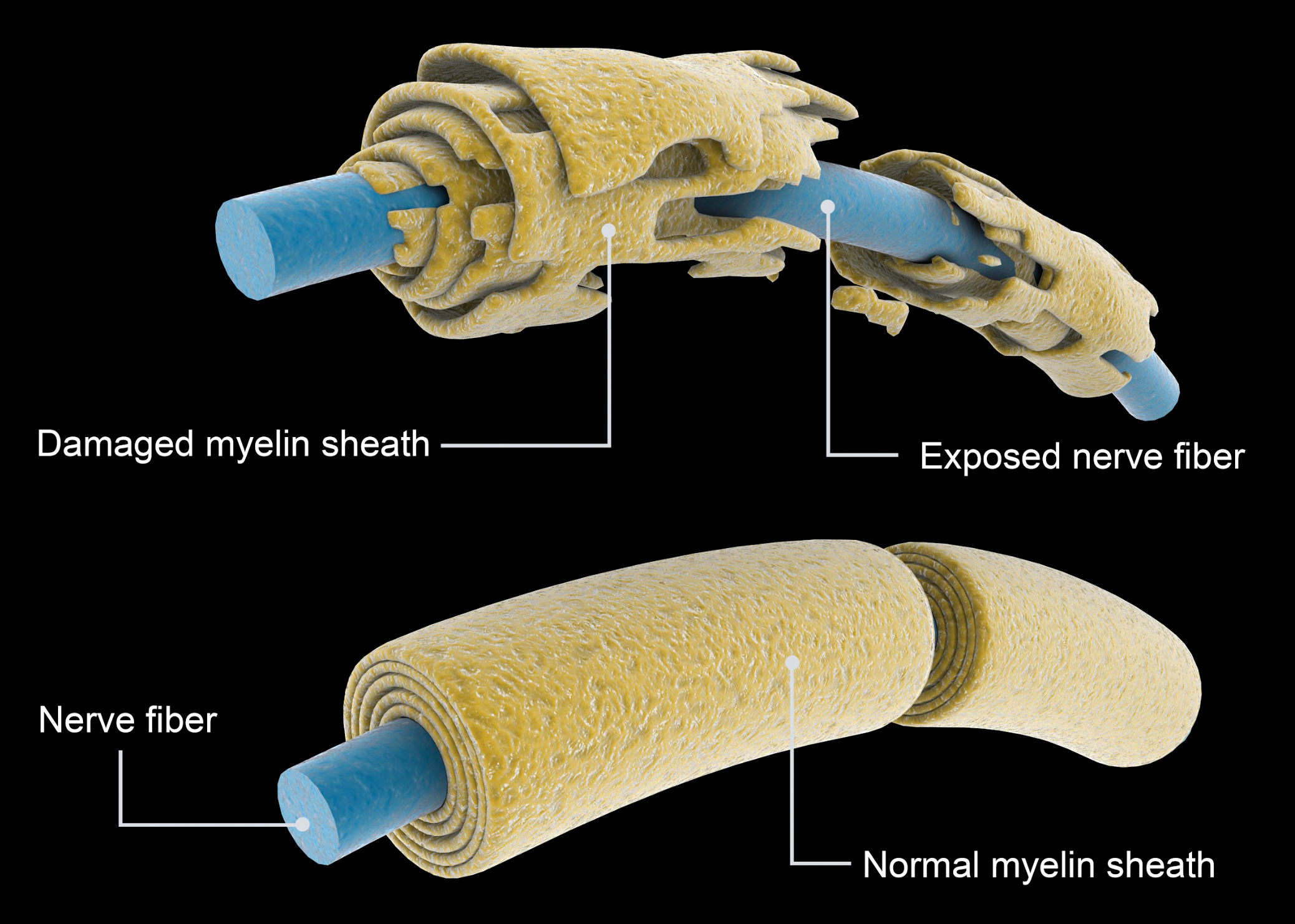 Damage myeline sheath of Multiple Sclerosis