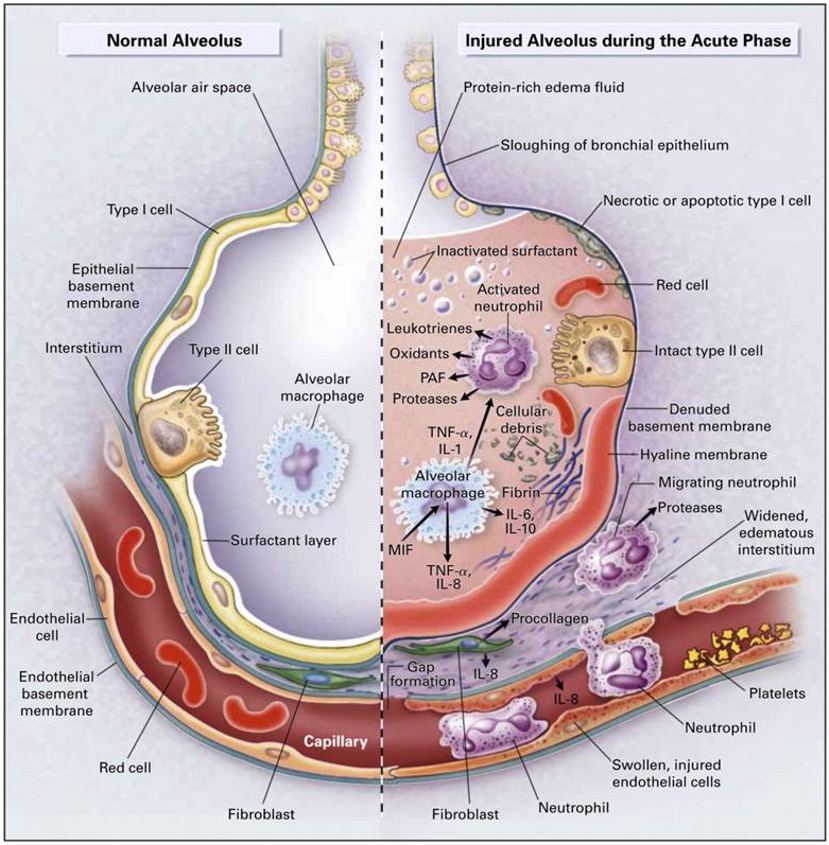A diagram of the normal alveolus and injured alveolus during acute ARDS phase