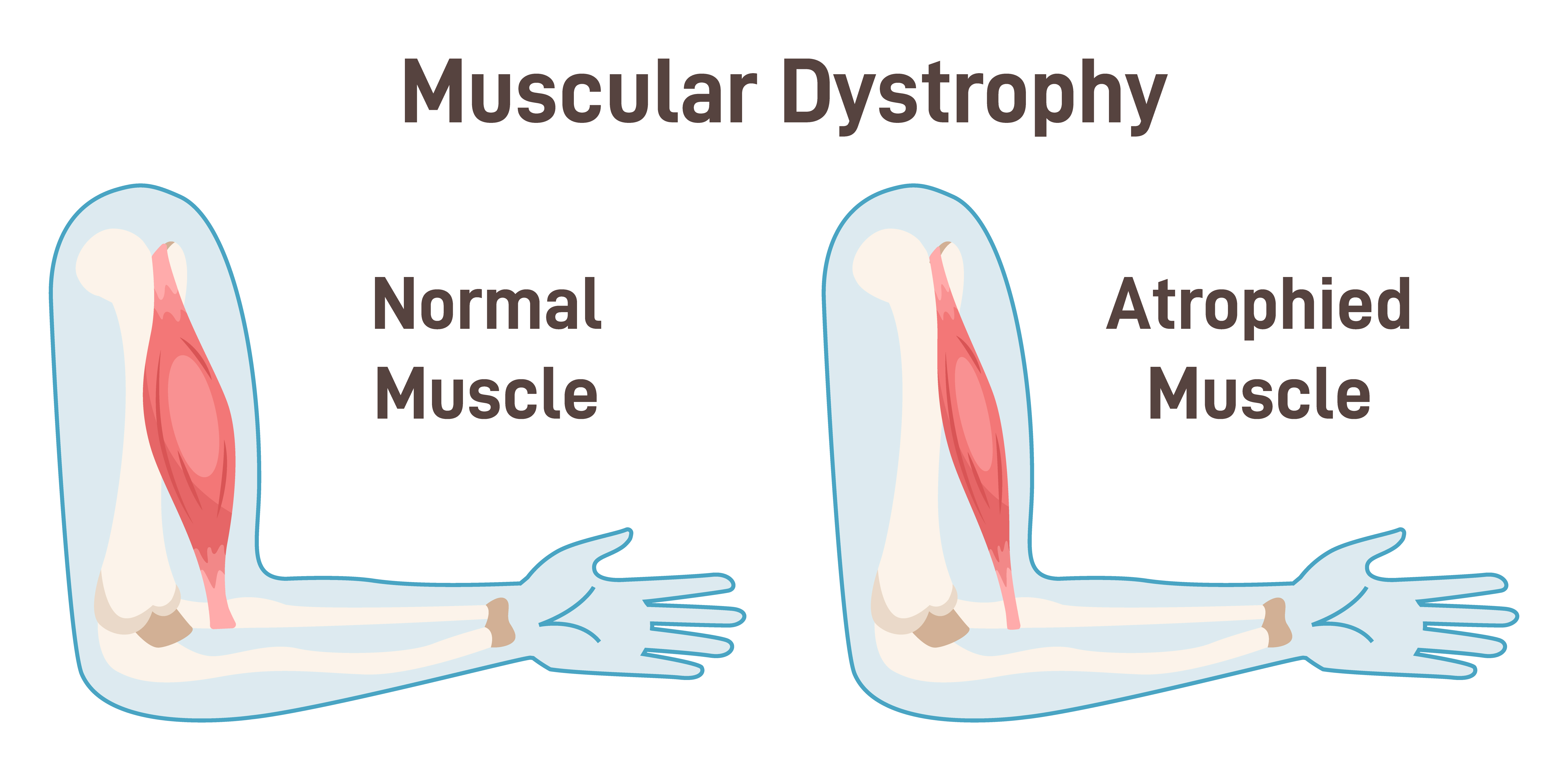 Illustration of normal muscle and atrophied muscle